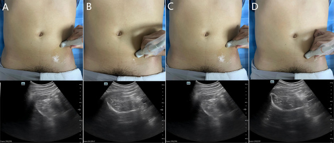 Pericapsular Nerve Group Block for Hip Fracture Pain Management: A Narrative Review of Emergency Applications.