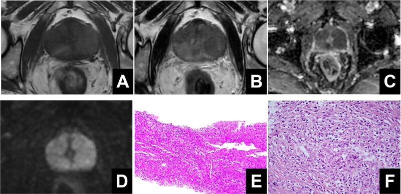 A case report of prostatic malacoplakia after heart transplantation and review of the literature.