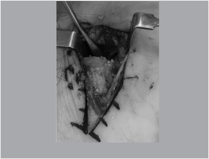 PLATE USING CANCELLOUS GRAFT VERSUS SCREW USING CANCELLOUS CORTICAL GRAFT IN THE TREATMENT OF SCAPHOID PSEUDARTHROSIS.