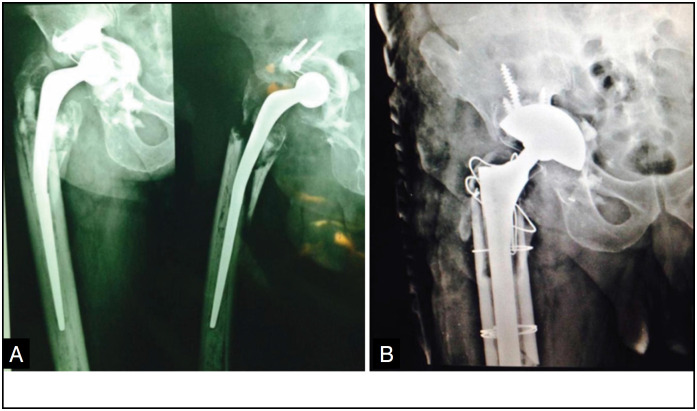 RADIOGRAPHIC AND FUNCTIONAL EVALUATION OF HIGH POROUS METAL OSSEOINTEGRATION IN ACETABULAR REVISIONS WITH PELVIC DISSOCIATION.