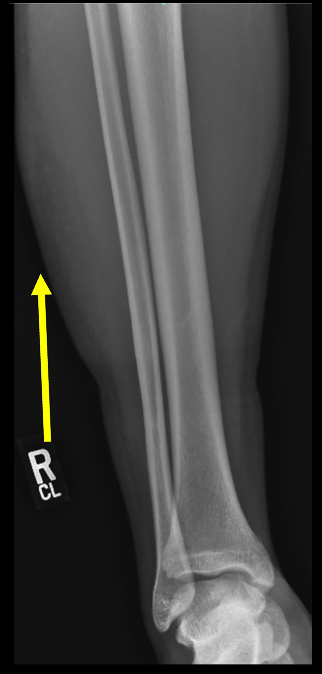 Adolescent Morel-Lavallée Lesions: A Case Report of Challenges in Diagnosis and Management in Atypical Locations.