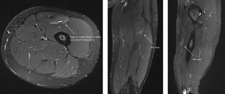 Operative Management of a Chronic Proximal Rectus Femoris Muscle Tear in a Collegiate Athlete: A Case Report.