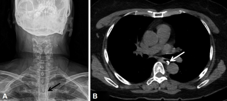 Esophageal Rupture Occurred During the Endoscopic Removal of a Lodged Denture.