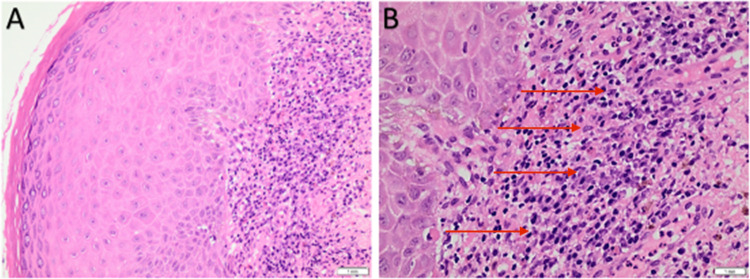 Balanitis Circumscripta Plasmacellularis in a Young Circumcised Male: A Case Report.