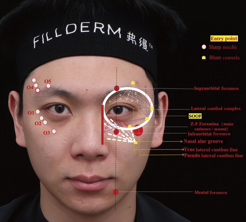 Collagen Use in Periorbital Rejuvenation for Chinese Patients: The Restoration Injection for Optimal Rejuvenation Technique.