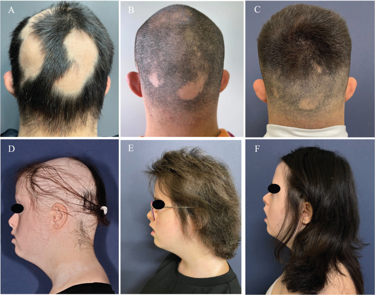 JAK Inhibitors in Down Syndrome: Alopecia Areata Resolution and Vitiligo Improvement with Baricitinib.