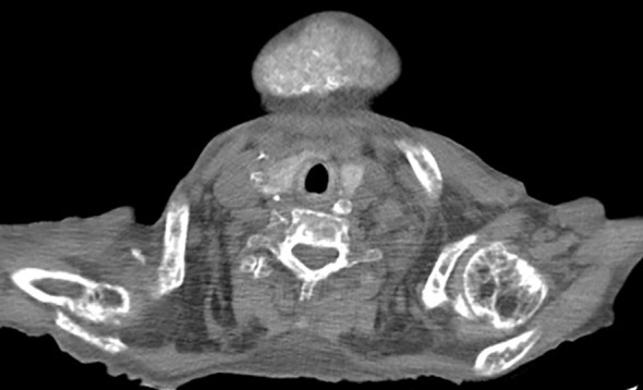Severe consequences of uncontrolled tertiary hyperparathyroidism in a limited resources setting: a case report.