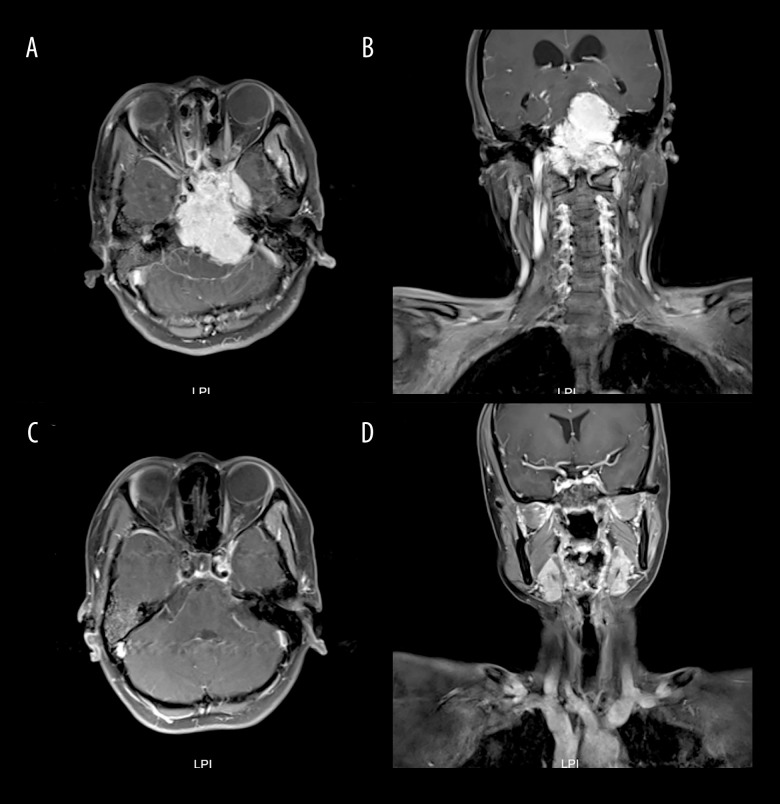 Nasopharyngeal Giant Carcinoma Mimicking Intracranial Lesions: A Case Report and Literature Review.