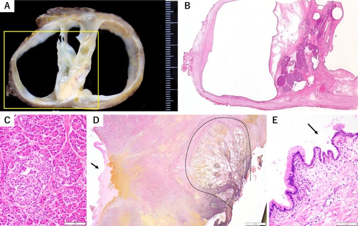 Hemiclamshell Resection of a Ruptured Mediastinal Teratoma Exhibiting Pancreatic Differentiation.
