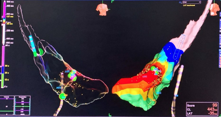 Effectiveness and Safety of Radiofrequency Catheter Ablation Using Three-Dimensional Electroanatomic Mapping Systems in Treating Ventricular Arrhythmias: A Single-Center Prospective Cohort Study in Vietnam.