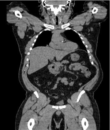 Pulmonary Aspergillosis Mimicking Metastatic RCC: A Postnephrectomy Diagnostic Consideration.
