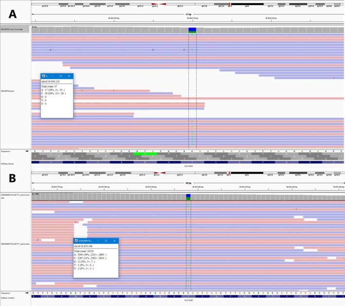 Novel Pathogenic Genotype in SLC12A3 Associated to Gitelman Syndrome: A Case Report.