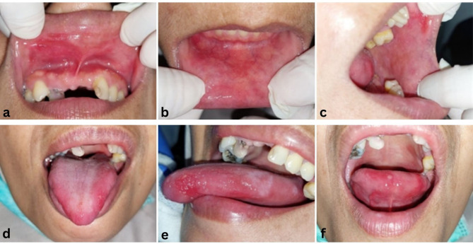 Salted Fish and Their Impact on Oral Health: A Risk for Lichen Planus.