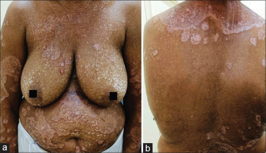 Morpheaform Sarcoidosis - A Very Rare Presentation of Sarcoidosis with a Brief Review of Literature.