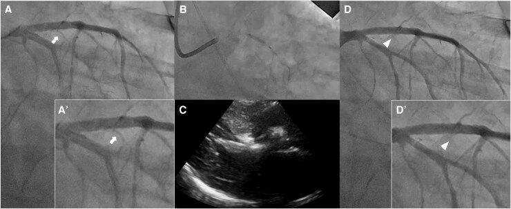 Rescue percutaneous transluminal septal myocardial ablation for difficult ventilator weaning in drug-resistant hypertrophic obstructive cardiomyopathy: a case report.