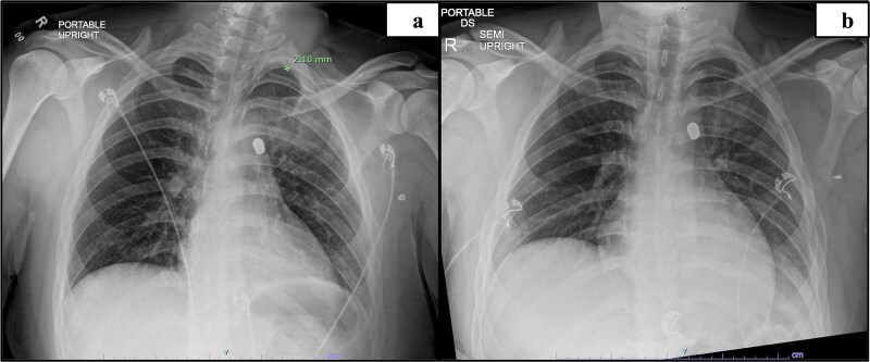 Case study: robotic foreign body removal of bullet in the aortopulmonary window.