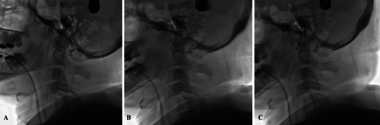 A unique management strategy to bilateral vertebral artery occlusion following cervical trauma: illustrative case.
