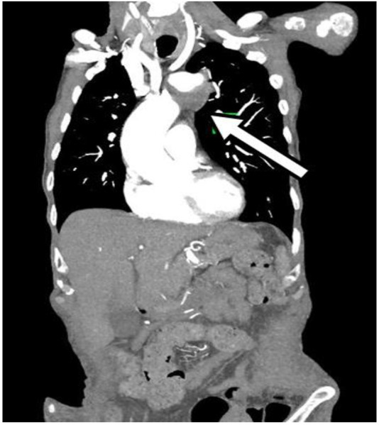 <i>Mycobacterium bovis</i>, a rare causative pathogen of multiple pseudoaneurysms.