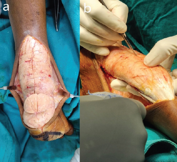 Massive Tendo Achilles Xanthoma Treated with en bloc Excision and Reconstruction with Flexor Hallucis Longus Tendon Transfer: A Case Report.