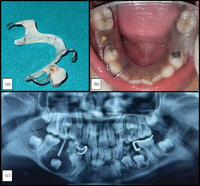 Successful Preservation of a Developing Unerupted Tooth Associated With Dentigerous Cyst in a Child: A Case Report.