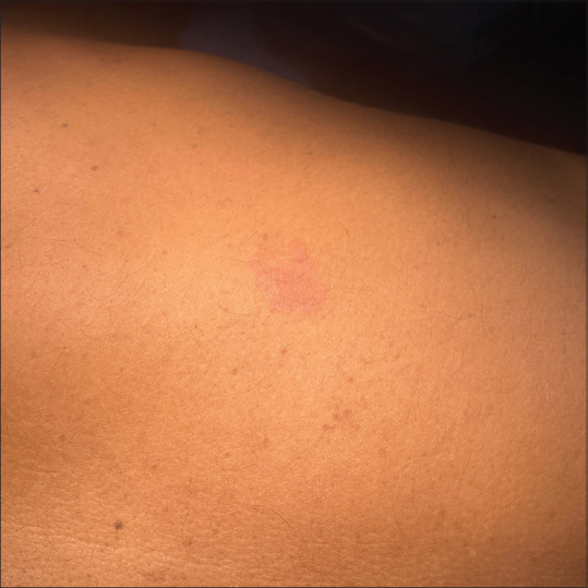 Bilateral Hyperpigmented Linear Streaks on The Face: An Unusual Presentation of Allergic Contact Dermatitis.