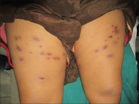 Trans-Epidermal Elimination Due to Insulin Formulation: Report of a Rare Adverse Effect.