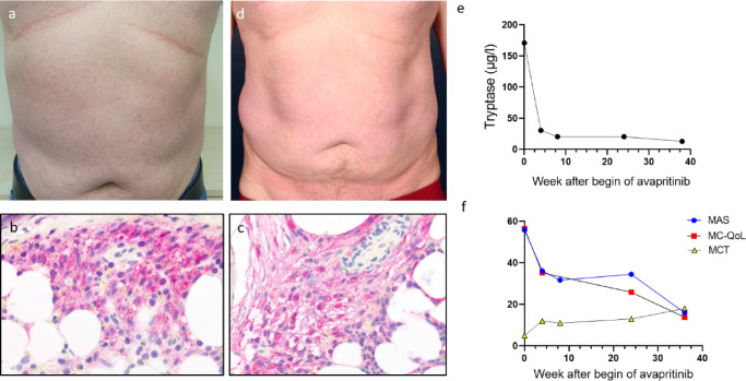 Avapritinib reduces symptoms and mast cell burden in systemic mastocytosis.