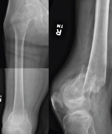 Treatment of Bilateral Distal Femoral Shaft Fractures in a Paraplegic Patient with Intramedullary Nailing: A Case Report.
