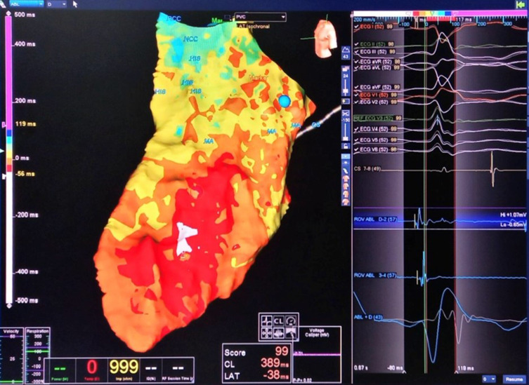 Effectiveness and Safety of Radiofrequency Catheter Ablation Using Three-Dimensional Electroanatomic Mapping Systems in Treating Ventricular Arrhythmias: A Single-Center Prospective Cohort Study in Vietnam.