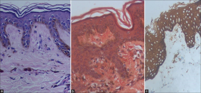 Familial Primary Cutaneous Amyloidosis Across Generations.