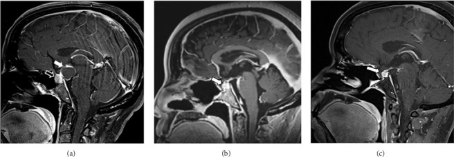 Pituitary Macroadenoma and Adamantinomatous Craniopharyngioma: A Rare Case Report of Sellar Collision Tumors.