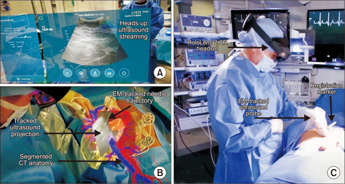 <i>In-vivo</i> evaluation of an augmented reality enhanced ultrasound needle guidance system for minimally invasive procedures in porcine models: a preclinical comparative study.
