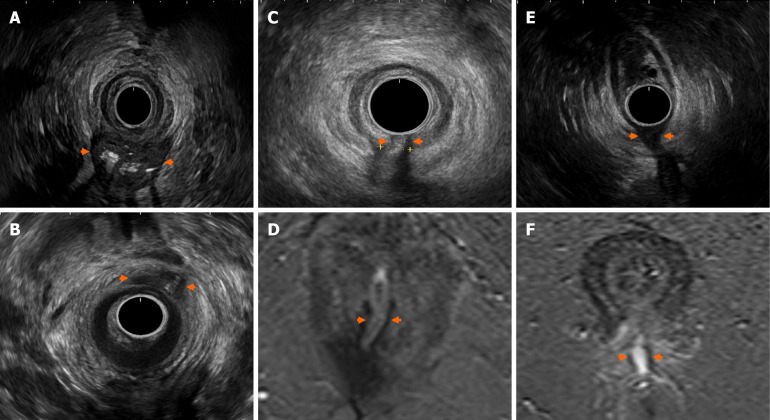 Imaging in perianal fistulising Crohn's disease: A practical guide for the gastroenterologist.