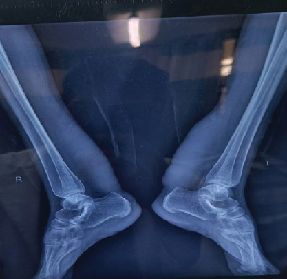 Bilateral Tendoachilles Xanthoma in a Young Female: A Rare Case Report.