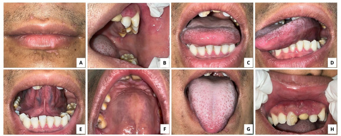 Striking Oral Manifestation of Primary Herpetic Gingivostomatitis: A Case Report and Review of Human Herpesvirus Infections.