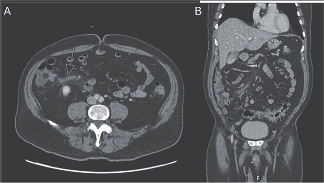 Ileocolic venous thrombophlebitis from associated enteropathogenic <i>E. coli</i> infection.