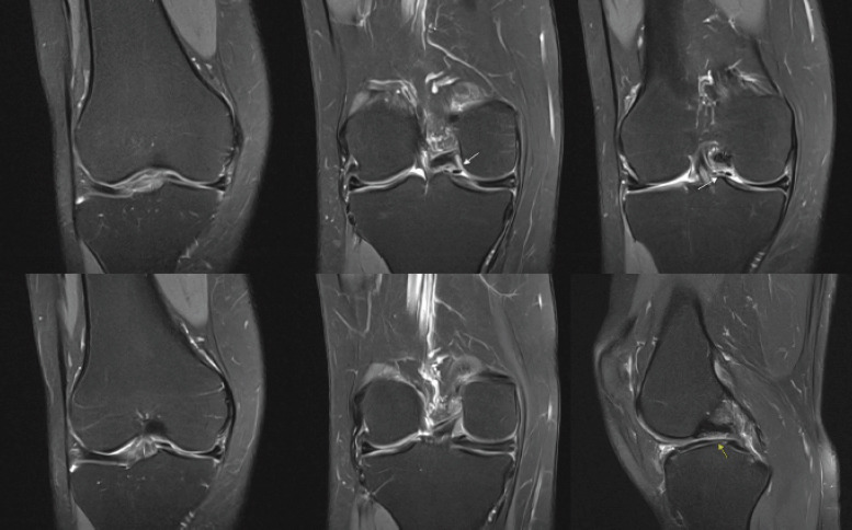 An Anomalous Attachment of the Medial Meniscus Posterior and Anterior Roots Mimicking a Bucket Handle Meniscus Tear: A Case Report and Review of the Literature.
