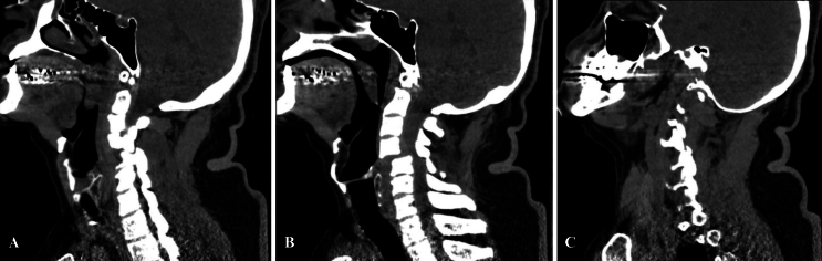 A unique management strategy to bilateral vertebral artery occlusion following cervical trauma: illustrative case.