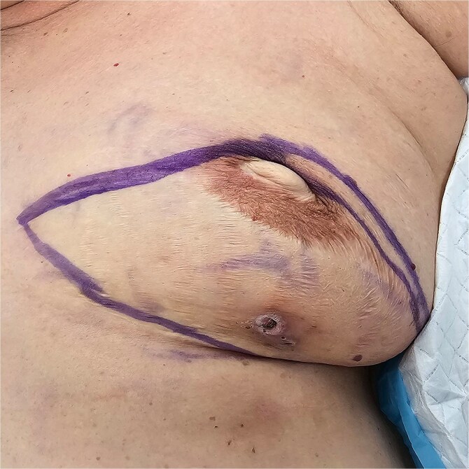 Pedicled transverse rectus abdominis myocutaneous flap removal after 21 years: a case report.