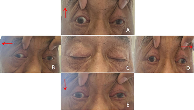 Bilateral Oculomotor Nerve Palsy: A Rare Complication of Bridging Thrombolysis for Acute Basilar Artery Occlusion.