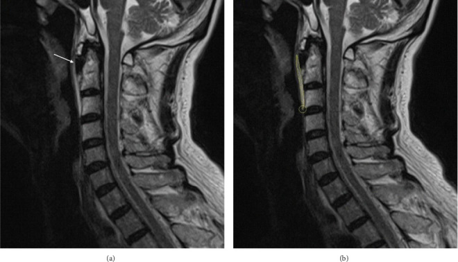 Longus Colli Tendinitis: Analysis of MRI and Clinical Features With Predictive Pain Risk Model Development.