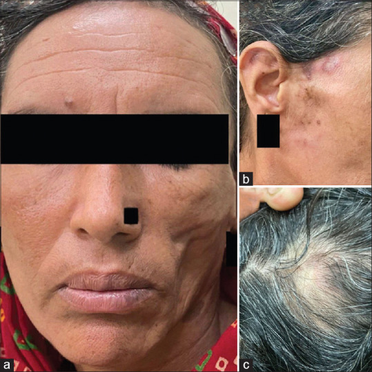 Parry-Romberg Syndrome with Localized Plaque Morphea and Localized Discoid Lupus Erythematosus: A Case Report of a Rare Overlap.