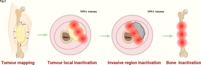Limb-sparing surgery combined with local inactivation by ablation improves local control in soft-tissue sarcomas : a comparative study with long-term follow-up.