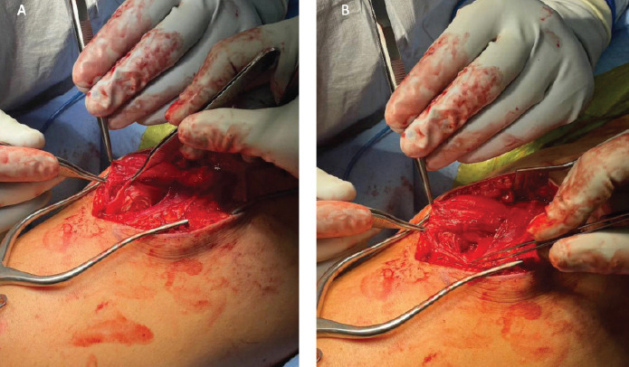 Operative Management of a Chronic Proximal Rectus Femoris Muscle Tear in a Collegiate Athlete: A Case Report.