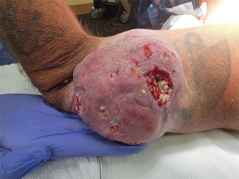 Skin adnexal tumor pilomatrix disease: a transformation from benign to malignant.