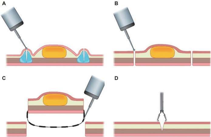 Recent Advances in Endoscopic Treatment Techniques for Subepithelial Lesions.