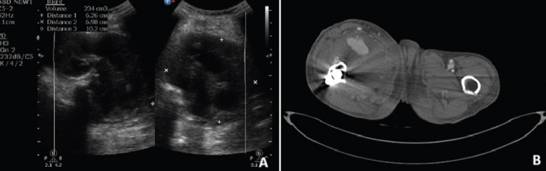 A Rare Case of Pseudoaneurysm of Profunda Femoris Artery Following Surgical Fixation of an Intertrochanteric Fracture.