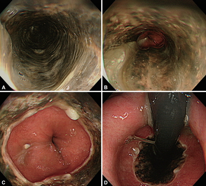 A Case of Black Esophagus in a Patient Presenting With Dyspnea.