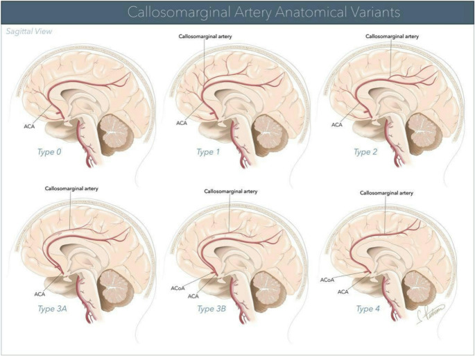 Callosomarginal artery: an in-depth of anatomical characteristics, clinical significance, neurosurgical considerations, and surgical applications.