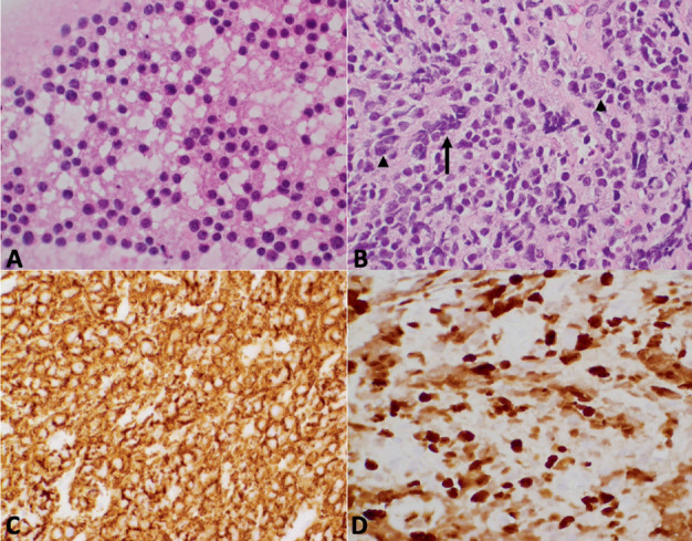 A Rare Presentation of Adult Primary Leptomeningeal Medulloblastoma: Case Report.